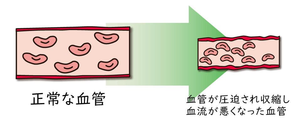 緊張型頭痛