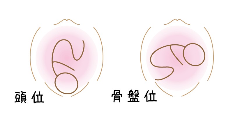 逆子:骨盤位