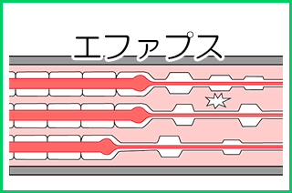 顔面神経麻痺:後遺症のけいれん