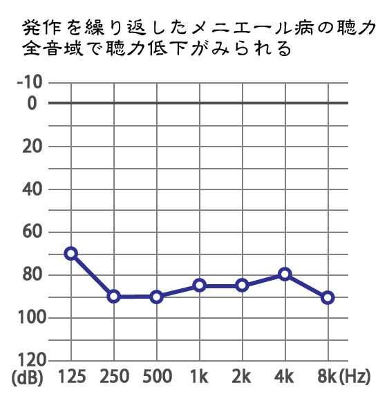 メニエール病:難聴の聴力水平型